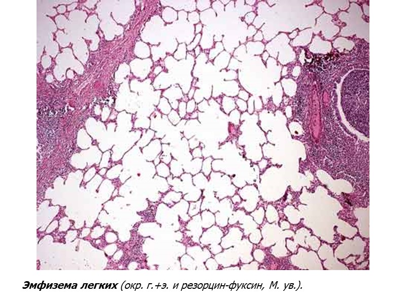 Эмфизема легких (окр. г.+э. и резорцин-фуксин, М. ув.).